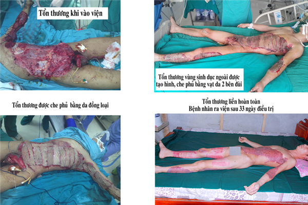 Điều trị thành công một ca bệnh chấn thương mất da diện rộng 32% diện tích cơ thể